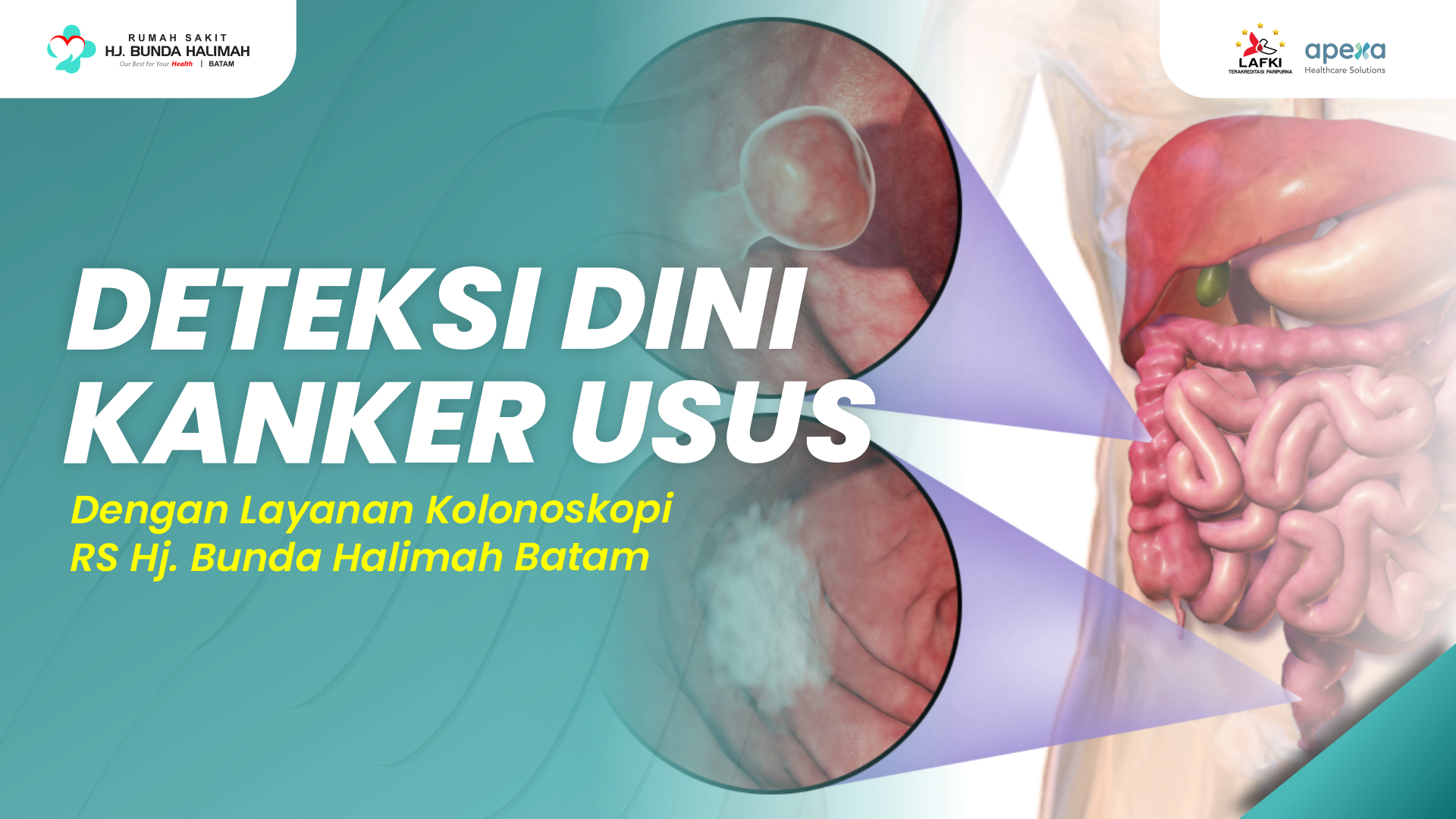 Deteksi dini kanker usus dengan Layanan Kolonoskopi RS Hj. Bunda Halimah Batam